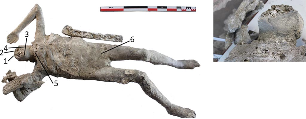 Victim 55. Cast #55 and pXRF measuring points (1–6).
The cast #55 belongs to a male adult between 25 and 30 years old, originally in supine position, with the upper extremities separated from the body, and the forearms and hands on the head.
The radiological examination also revealed traumatic perimortem fractures in the tibia and fibula of the right leg of the cast #58 and in the right humerus of the cast #55. These fractures appear to have occurred close to the time of death of the individuals.
Photo courtesy of The Casts of Pompeii Project. Use subject to CC BY 4.0 Deed 
See Alapont L, Gallello G, Martinón-Torres M, Osanna M, Amoretti V, Chenery S, et al. (2023) The casts of Pompeii: Post-depositional methodological insights. PLoS ONE 18(8): e0289378, fig. 7. https://doi.org/10.1371/journal.pone.0289378 

