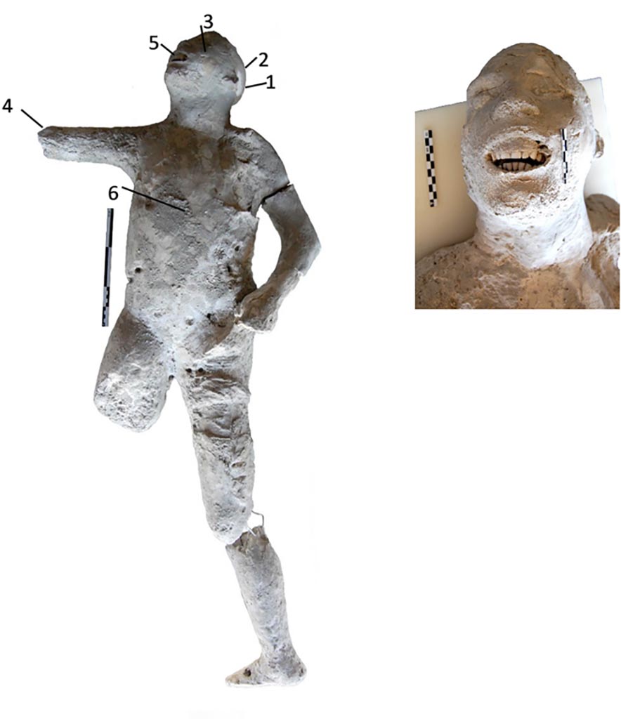 Victim 57. Cast #57 and pXRF measuring points (1–6).
The cast #57 is an adult individual (25–30 years old). He was found supine and has some flexed or lopsided anatomical areas. 
The skull is inclined to the right and the chest is straight, presenting its coxofemoral joint slightly rotated towards its medial aspect.
The cast #57 shows dental wear of the incisors and canines of the upper jaw, product of its axial shaft, and erosion of the lower incisors. 
Photo courtesy of The Casts of Pompeii Project. Use subject to CC BY 4.0 Deed 
See Alapont L, Gallello G, Martinón-Torres M, Osanna M, Amoretti V, Chenery S, et al. (2023) The casts of Pompeii: Post-depositional methodological insights. PLoS ONE 18(8): e0289378, Fig 2. https://doi.org/10.1371/journal.pone.0289378 

Victim 57 is a young male aged 13-19 years.
Some imprints of the fabric of a tunic are visible near the side and the left thigh.
The body was found between the 2nd of August and the 21st of September 1976, outside the Porta Nola near the tomb of M. Obellius Firmus.
See Osanna, N., Capurso, A., e Masseroli, S. M., 2021. I Calchi di Pompei da Giuseppe Fiorelli ad oggi: Studi e Ricerche del PAP 46, p. 454-6, Calco n. 57.
